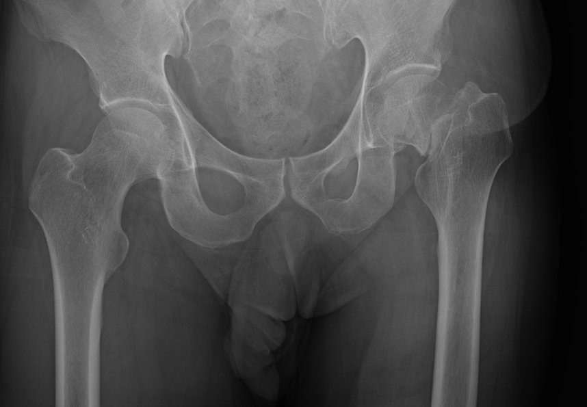 大腿骨骨折