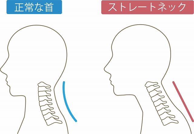 スマホ首・ストレートネックとは